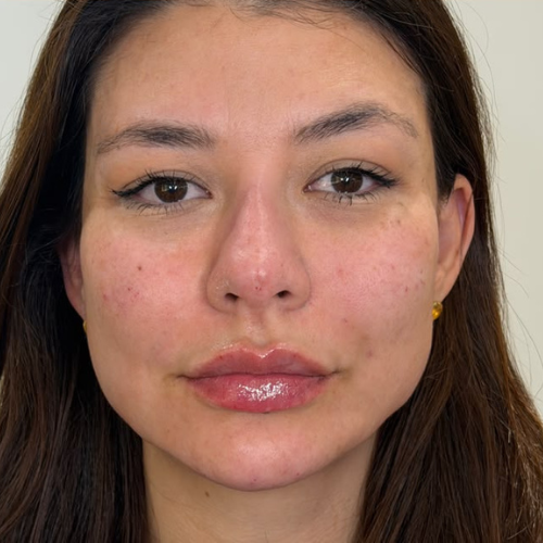 Depois — harmonização facial