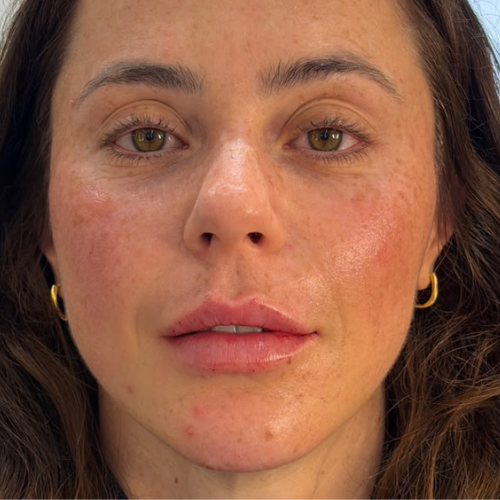 Depois — definição facial