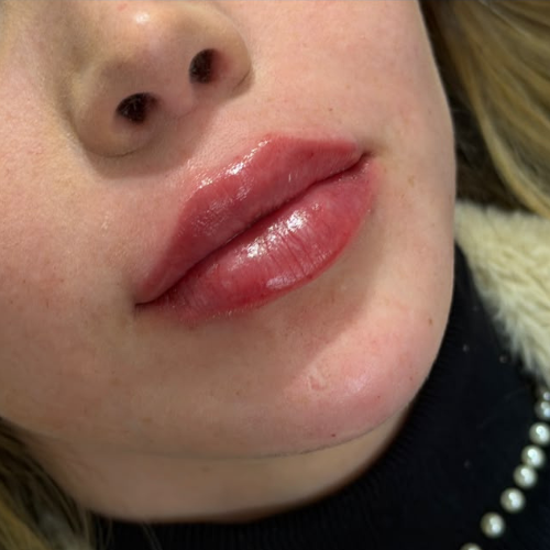 Depois — preenchimento labial